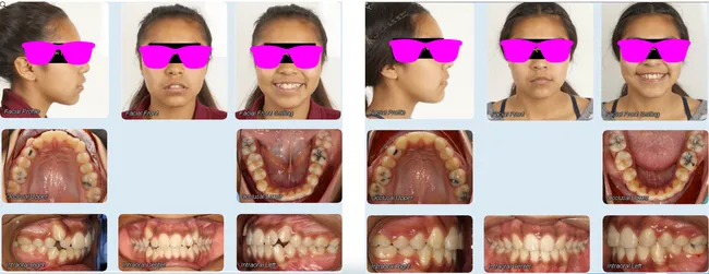 Case 2 - Before and after orthodontic treatment at Orthodontic Nations