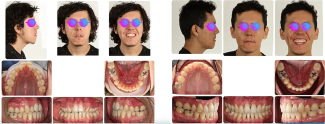 Case 4 - Before and after orthodontic treatment at Orthodontic Nations