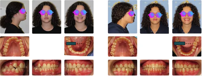 Case 6 - Before and after orthodontic treatment at Orthodontic Nations