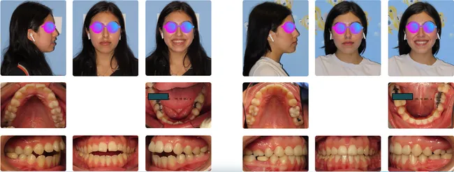 Case 8 - Before and after orthodontic treatment at Orthodontic Nations